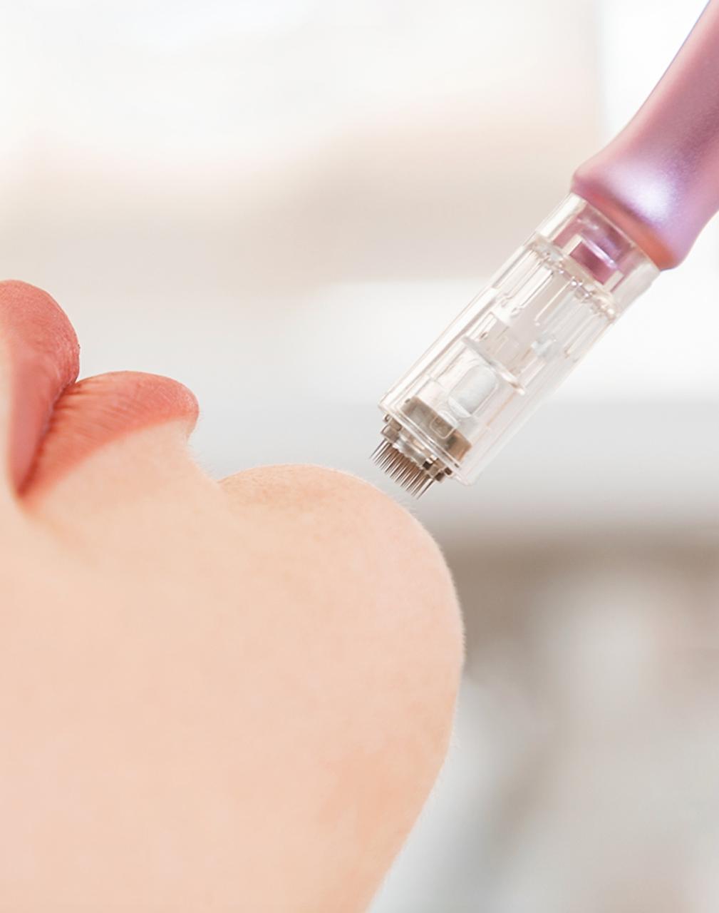 Microneedling et micro-aiguillage RF